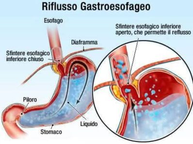 Reflusso